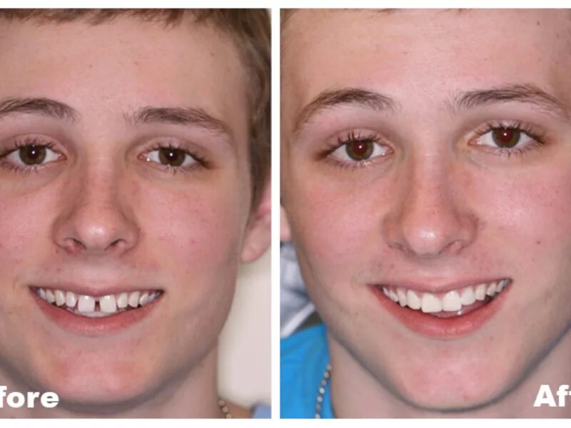 Щель между передними зубами. Щели между зубов до и после. Диастема зубов виниры до и после. Установленных до и после