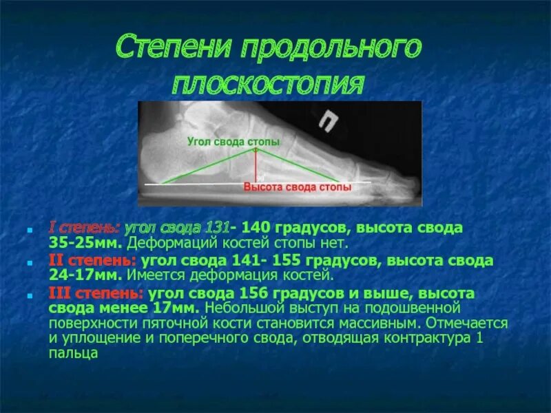 Плоскостопие 3 степени сколько градусов. Стадии продольного плоскостопия рентген. Продольное плоскостопие рентген степени. Степени плоскостопия на рентгене. Продольное плоскостопие 3 степени угол свода стопы.