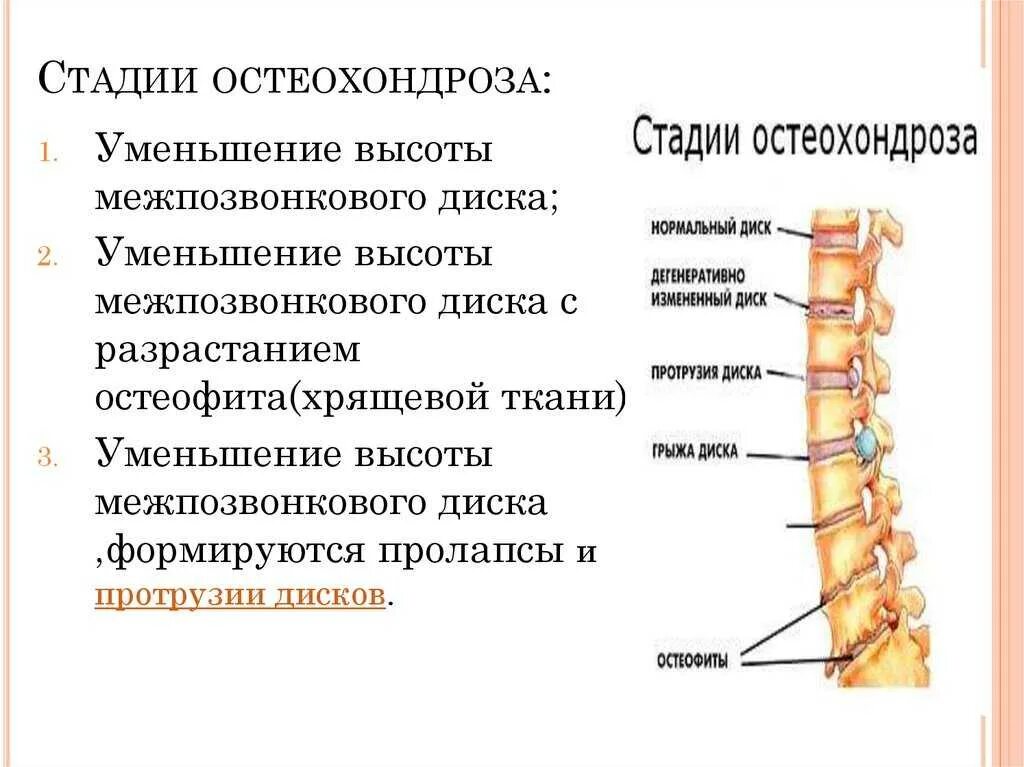 Можно ли вылечить шейный позвоночник. Этапы развития остеохондроза позвоночника. хондроз 2 степени поясничного отдела. степени и периоды остеохондроза шейного отдела. хондроз шейного отдела начальная стадия.