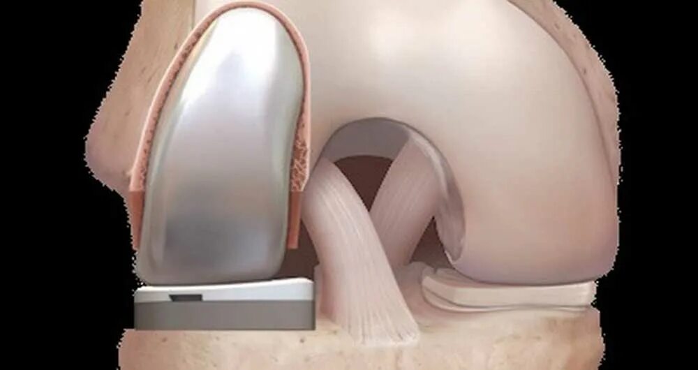 Хондромаляция надколенника 2 степени. Хондромаляция коленного сустава 3 стадия. Хондромаляция коленного сустава мрт. Хондромаляция надколенника коленного сустава. Хондромаляция надколенника outerbridge.