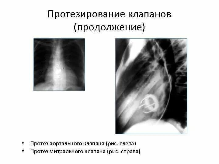 Протезирование клапана мкб. Протез митрального клапана сердца на рентгене. рентген протез митрального аортального клапана. эндопротез митрального клапана рентген. недостаточность аортального клапана рентген.