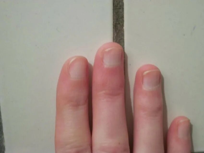 Eczema Early Stage Pictures 77 Photos & Images /