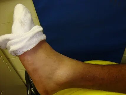 Sprained leg