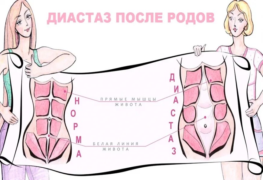 Диастаз прямых мышц живота. Расхождение прямых мышц живота.