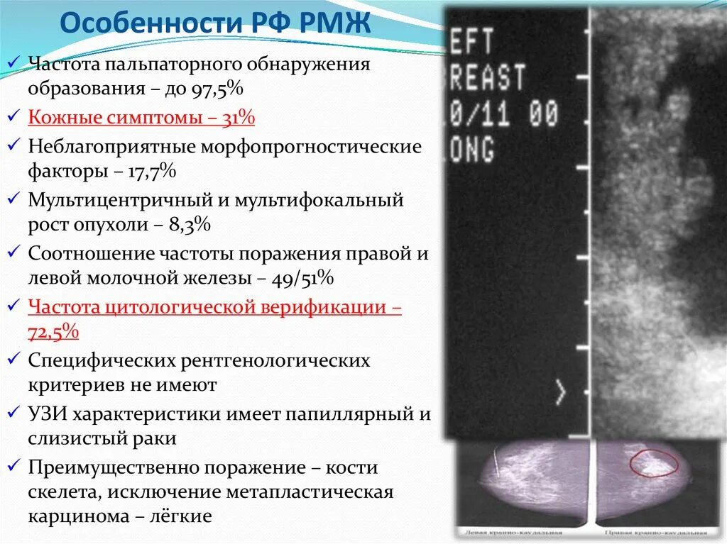 Рак молочной железы исцеление. Мультицентрическая опухоль молочной железы. Мультифокальный рост опухоли молочной железы. Мультицентрический рост злокачественной опухоли молочной железы. Локализация опухоли молочной железы.