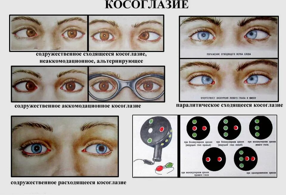 Альтернирующее косоглазие операция. Содружественное расходящееся альтернирующее косоглазие. Содружественное неаккомодационное косоглазие. Диагноз сходящееся содружественное косоглазие. Какой глаз левый а какой правый