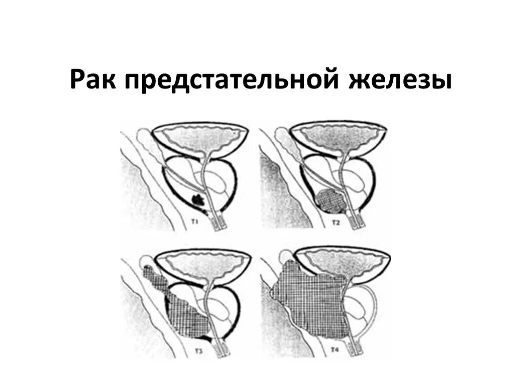 Простата хочет. Онкология предстательной железы. Простата рисунок. Простата и предстательная железа. Схема предстательной железы.