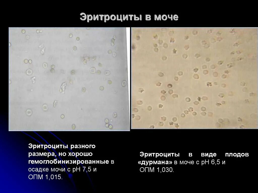 Почему повышены эритроциты в моче. Измененные эритроциты в моче микроскопия. Эритроциты в моче 2-3-4 в п ЗР. Микроскопия осадка мочи эритроциты измененные. Неизмененные эритроциты в моче микроскопия.