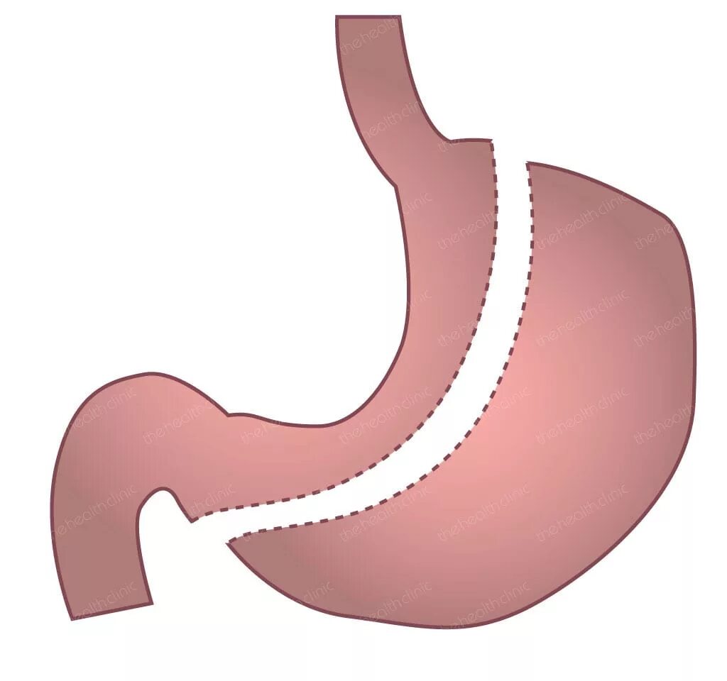 После удаления части желудка. Продольная резекция желудка _Sleeve Gastrectomy. Продольная резекция желудка (ПРЖ). Антрум резекции желудка.