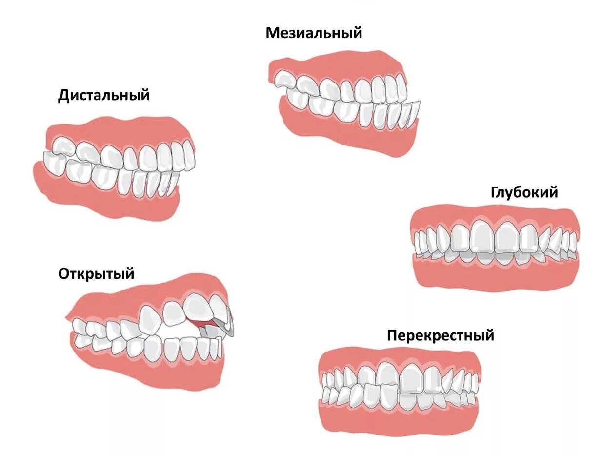 Как проверить прикус. Правильный прикус и неправильный прикус. типы прикусов зубов у человека. правильный прикус вид сбоку. прикус зубов правильный и неправильный у детей 4-5 лет.