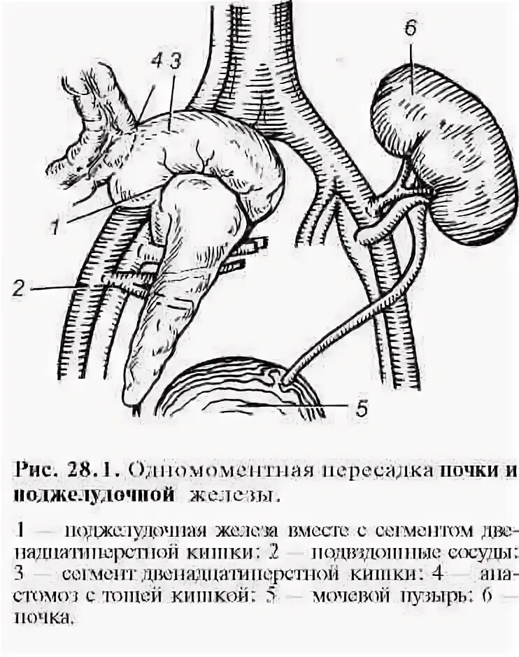 Пересадка железы при сахарном диабете. Трансплантация почки схема. Органная трансплантация поджелудочной железы. Анастомоз мочевого пузыря. Трансплантация поджелудочной железы и почки.