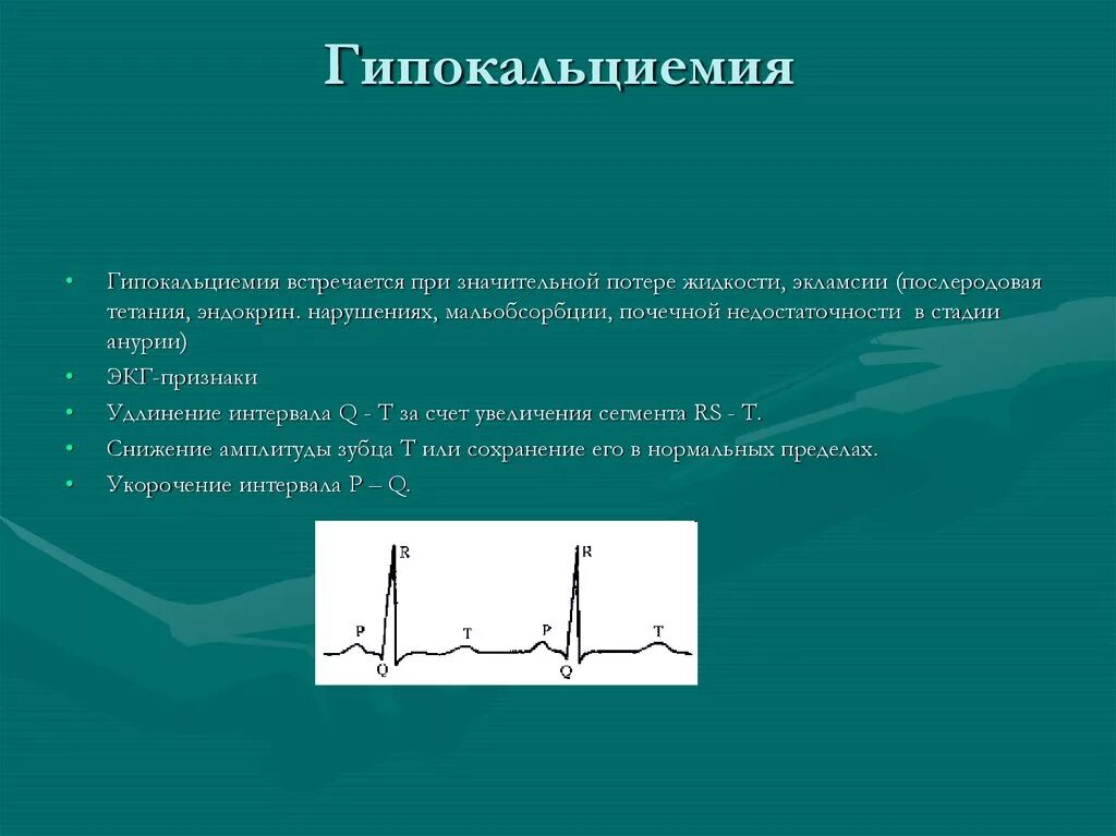 Гипокальциемия что это. Гипокальциемия при. гипокальциемия проявления. гипокальциемия основной симптом. qt экг при гипокальциемии.