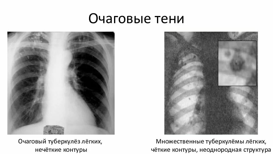 Очаговые тени не определяются. Затемнение на рентгенограмме. Синдром очаговых теней в легких. Подострый диссеминированный туберкулез рентген. Очаговые тени не определяются.
