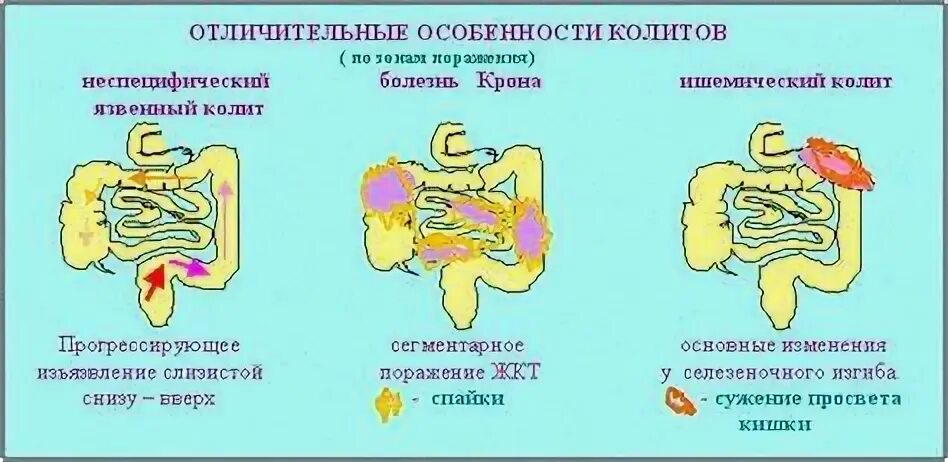 Как лечить колит кишечника у взрослых препараты. Как лечить колит кишечника у взрослых препараты