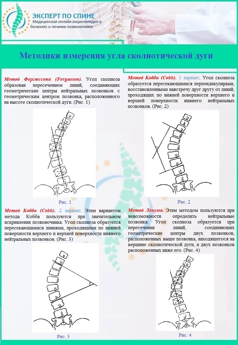 Методы выявления сколиоза. Угол Кобба степени сколиоза. Методика измерения сколиоза. S образный сколиоз 1 степени по чаклину. Угол кобба