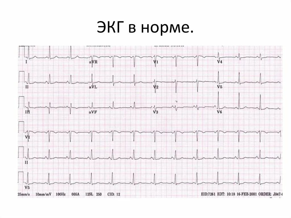 Нормальная кардиограмма ЭКГ. ЭКГ кардиограмма норма нормальная. ЭКГ норма пример. Норма ЭКГ во всех отведениях.