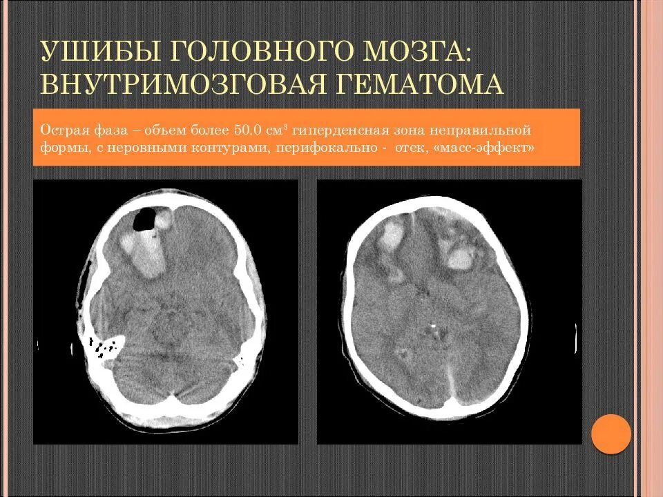 Гематомы мозга у детей. Внутримозговаяя гематомакт. внутримозговая гематома кт. кт мозга внутримозговая гематома.