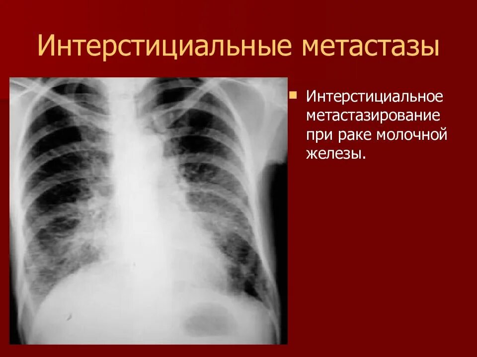 Метастазы в легкие при РМЖ. Метастаз саркомы в легкое описание. Признаки метастаз в легких