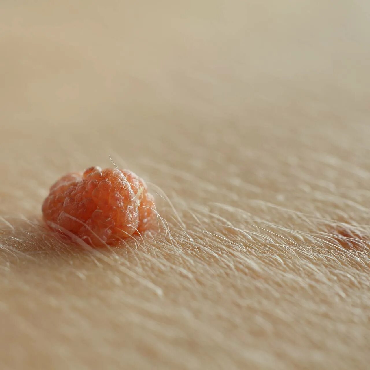 Вирус папилломы как выглядит на коже Pin on Santé