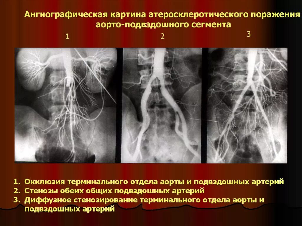 Атеросклеротические атеросклеротические поражения конечностей. Хронические облитерирующие заболевания артерий. Стентирование брюшной аорты рентген. Тромбоз общей подвздошной артерии рентген. Окклюзия общей подвздошной артерии.