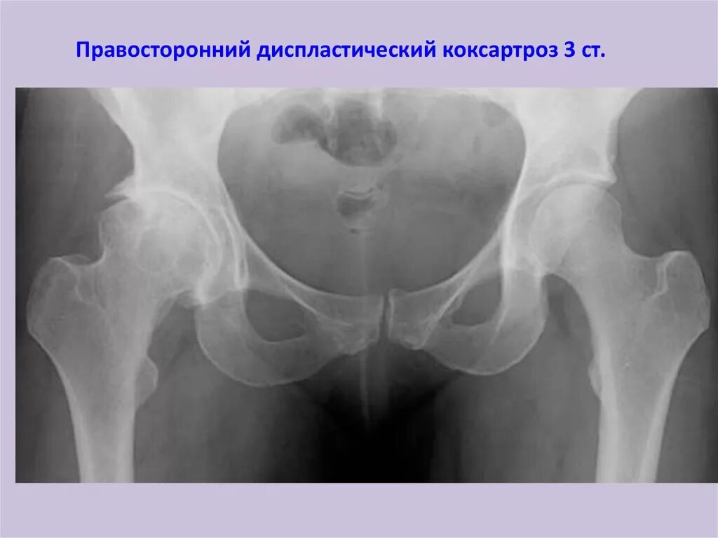 Операция тазобедренного сустава 1 степени. Коксартроз 1 степени рентген. Рентген коксартроза тазобедренного сустава 1 степени. Диспластический коксартроз РЕН. Диспластический коксартроз тазобедренного сустава 1.