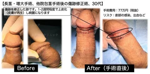 30 代.長 茎-増 大 手 術.他 院 包 茎 手 術 後 の 傷 跡 修 正 術 -彼 女 に 小 さ い と... 