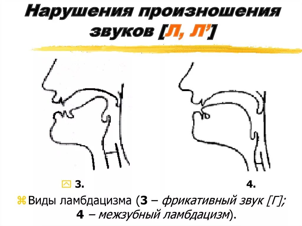 Недостатки произношения звуков. Недостатки произношения звуков л и л'.. Виды ламбдацизма в логопедии. Межзубное произношение звука л. Нарушение произношения звуков.