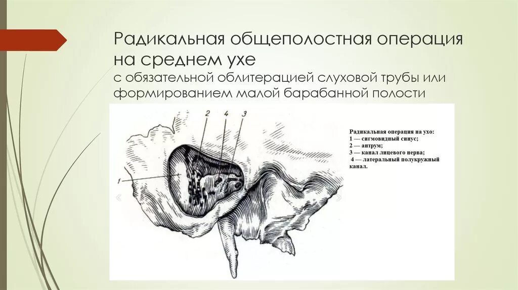 Операция на среднем ухе. Радикальная санирующая операция на среднем ухе. Расширенная санирующая операция на среднем ухе. Общеполостная операция на среднем ухе. Расширенная общеполостная операция на среднем ухе.