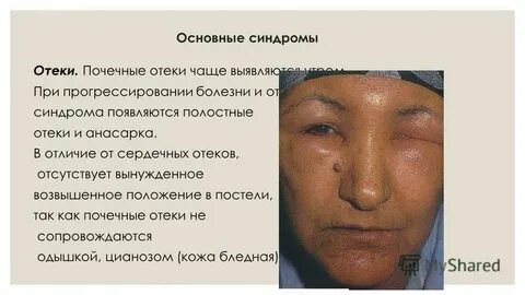 Отеки при заболеваниях почек