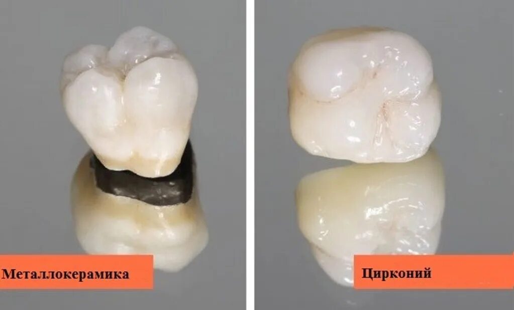 Что лучше циркониевая или металлокерамическая