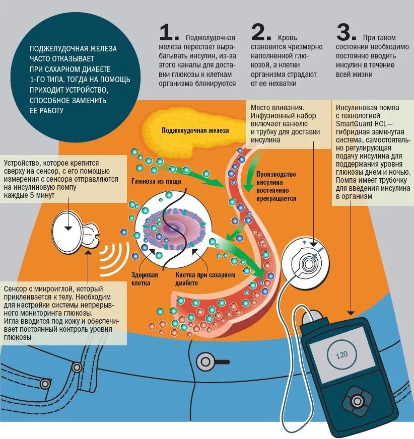 Искусственная поджелудочная железа. Портативная поджелудочная железа. Искусственная поджелудочная железа для диабетиков. Поджелудочная железа при сахарном диабете.