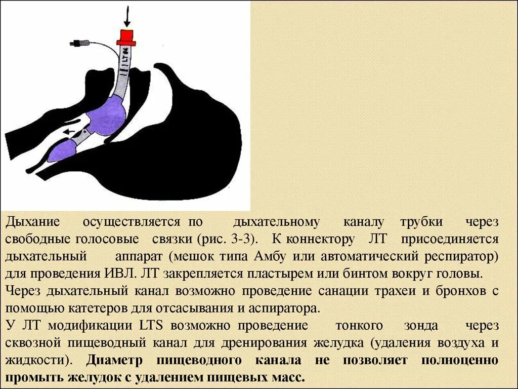 Удаление воздуха из желудка при искусственном дыхании. Удаление воздуха из желудка. Как убрать воздух из желудка. Устранение воздуха из желудка при ИВЛ. Обеспечение проходимости дыхательных путей.