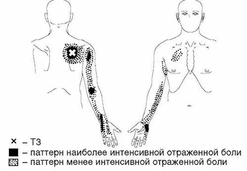 Карта отраженных болей. Болевые паттерны. Паттерн отраженной боли. Паттерн отраженной боли верхних конечностей. Отраженная боль это карта