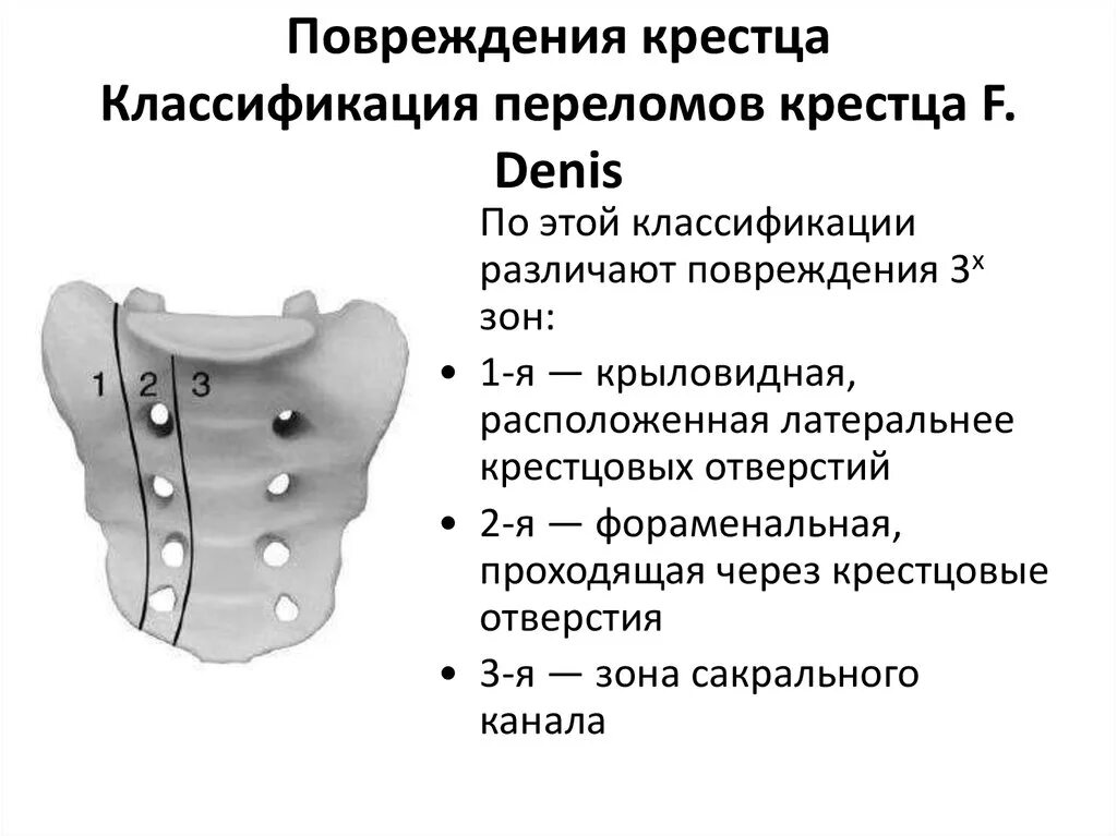 После операции на крестцовый отдел позвоночника. Классификация переломов крестца по Denis. Классификация Denis перелом крестца. Трабекулярный перелом крестца. Переломы крестца остеосинтез.