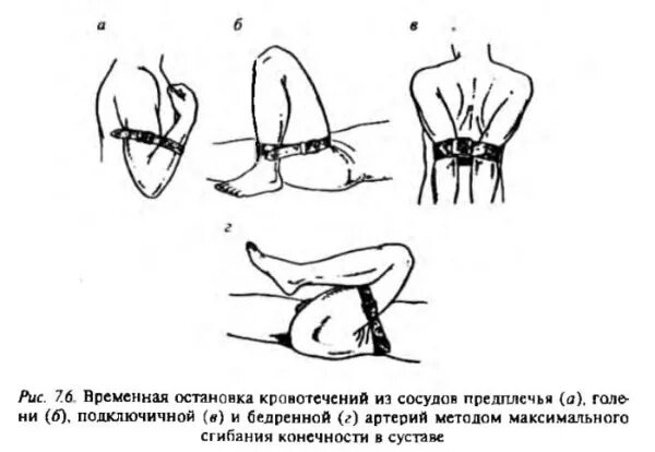 Остановка кровотечения путем сгибания конечности. Временная остановка кровотечения подколенная артерия. Остановка кровотечения способом сгибания конечности. Максимальное сгибание конечности для остановки кровотечения. Остановка кровотечения из подключичной артерии.