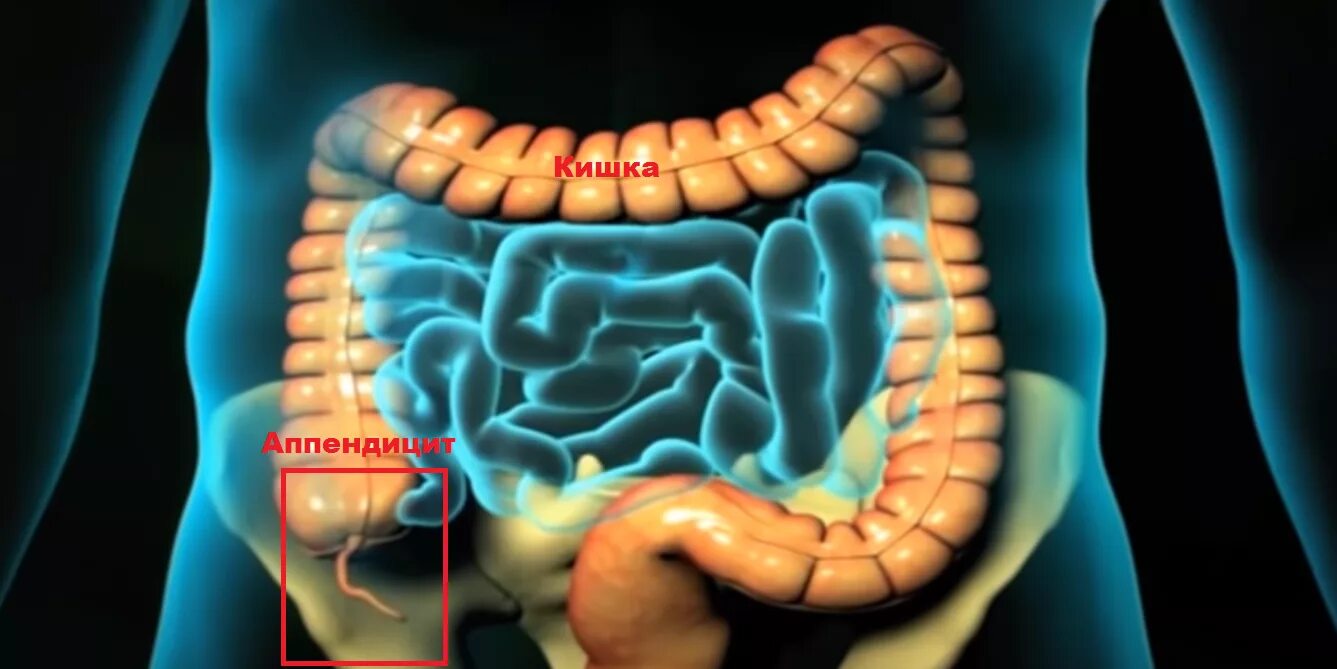 Острый аппендицит фото. Толстая кишка аппендикс
