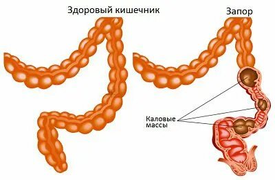 Нет стула и температура. Нет стула и температура