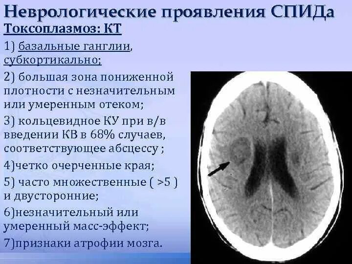Токсоплазмоз у вич инфицированных. Токсоплазмоз на кт головного мозга. токсоплазмоз головного мозга при вич инфекции кт.