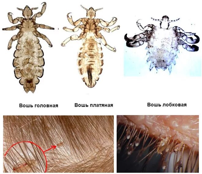 Педикулез карта. Вошь платяная (Pediculus humanus humanus. Вошь платяная и вошь лобковая.