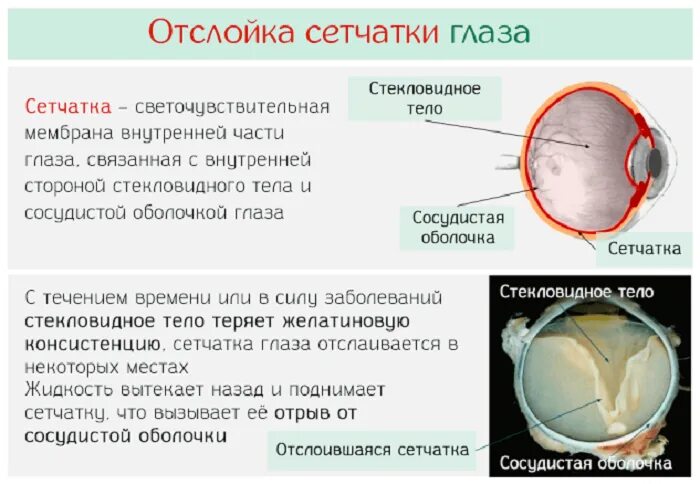 Причины первичной отслойки сетчатки. Глазное дно отслоение сетчатки. Регматогенная отслойка сетчатки симптомы. Назовите основные методы лечения отслойки сетчатки..