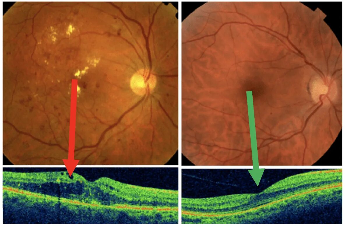 Макулярный отек лечение. Пролиферативная диабетическая ретинопатия. Диабетическая ретинопатия сетчатки. ХЛОРОХИНОВАЯ ретинопатия. Диабетическая ретинопатия глазное дно.