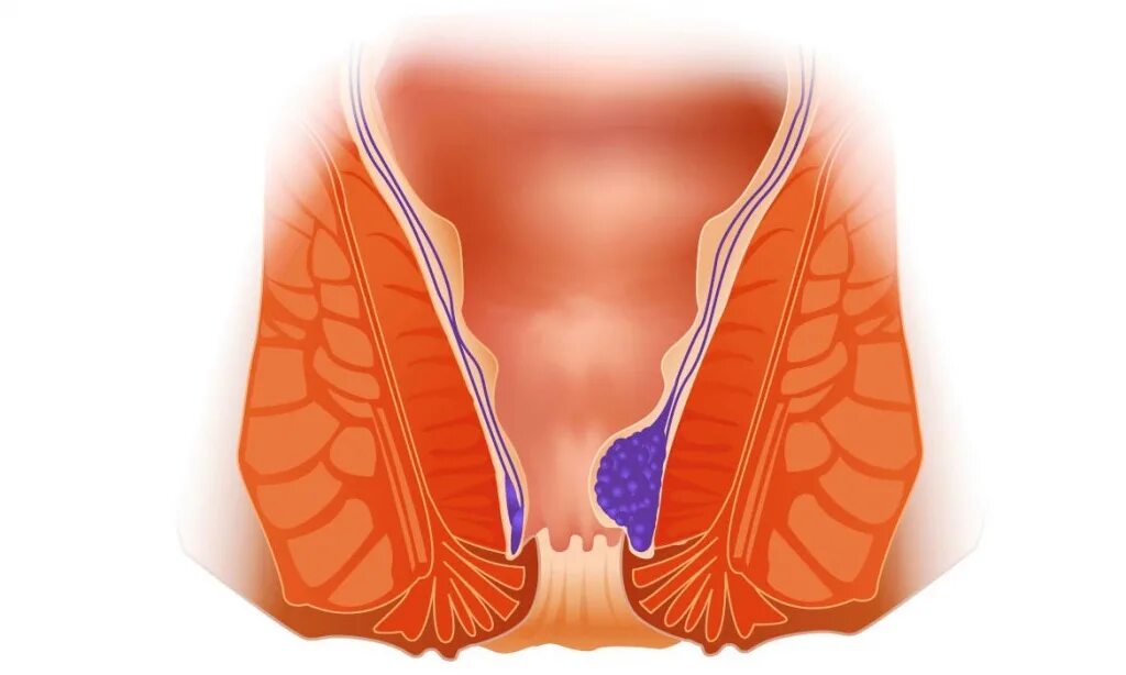 Дезартеризация геморроя. Дезартеризация геморроидальных узлов. Дезартеризация прямой кишки. Геморроидальными узлами снаружи ануса. Боли внутри заднего прохода