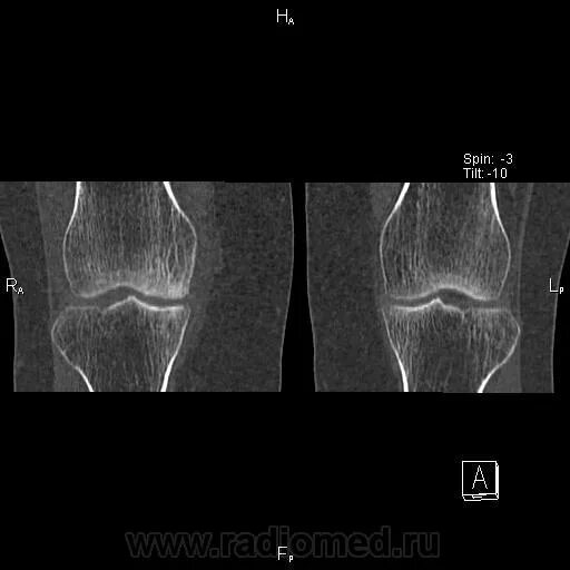 Асептический некроз коленного кт. Асептический некроз коленного сустава рентген. Асептический некроз мыщелка бедренной кости кт. Асептический некроз коленного сустава кт.