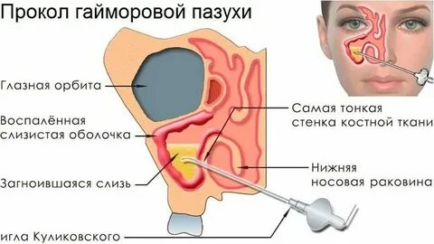 Болит пазуха и зубы