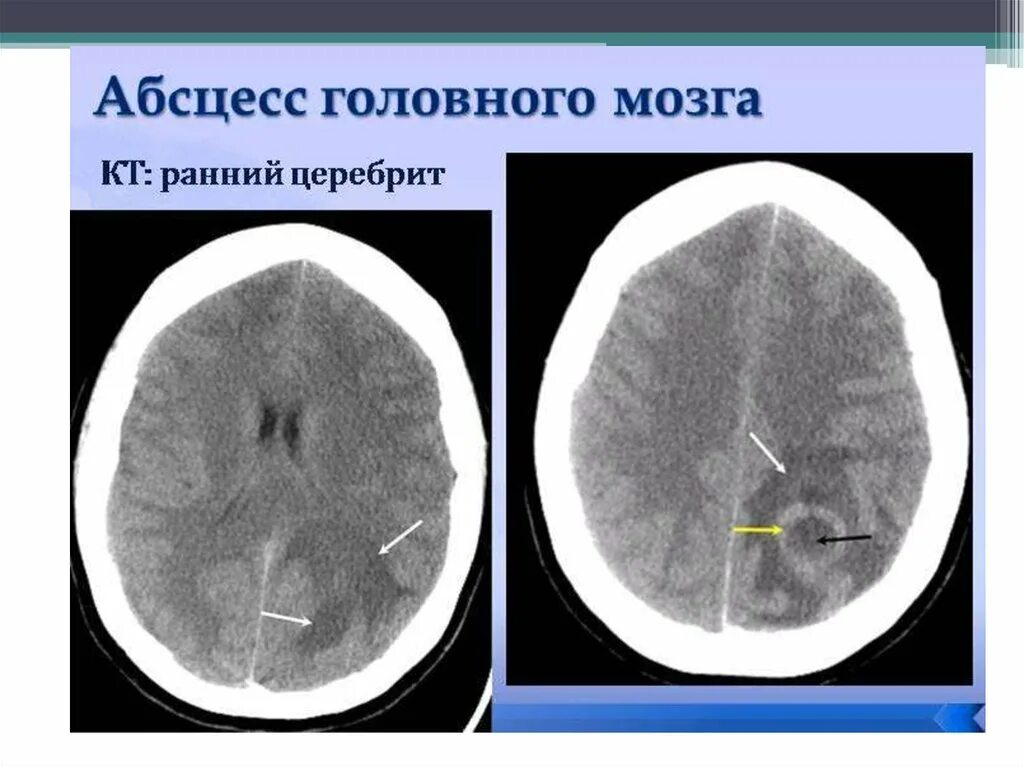 Головного мозга на ранних. Эпидуральный абсцесс головного мозга кт. Кт при абсцессе головного мозга. Абсцесс головного мозга мрт картина. Этапы формирования абсцесса головного мозга.