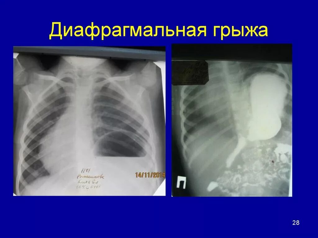 Диафрагмальный симптом