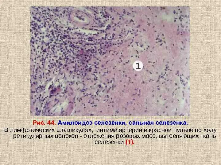 Ткань селезенки. Амилоидоз селезенки препарат. Амилоидоз селезенки саговая селезенка микропрепарат. Амилоидоз селезенки макропрепарат. Амилоидоз селезенки микропрепарат.