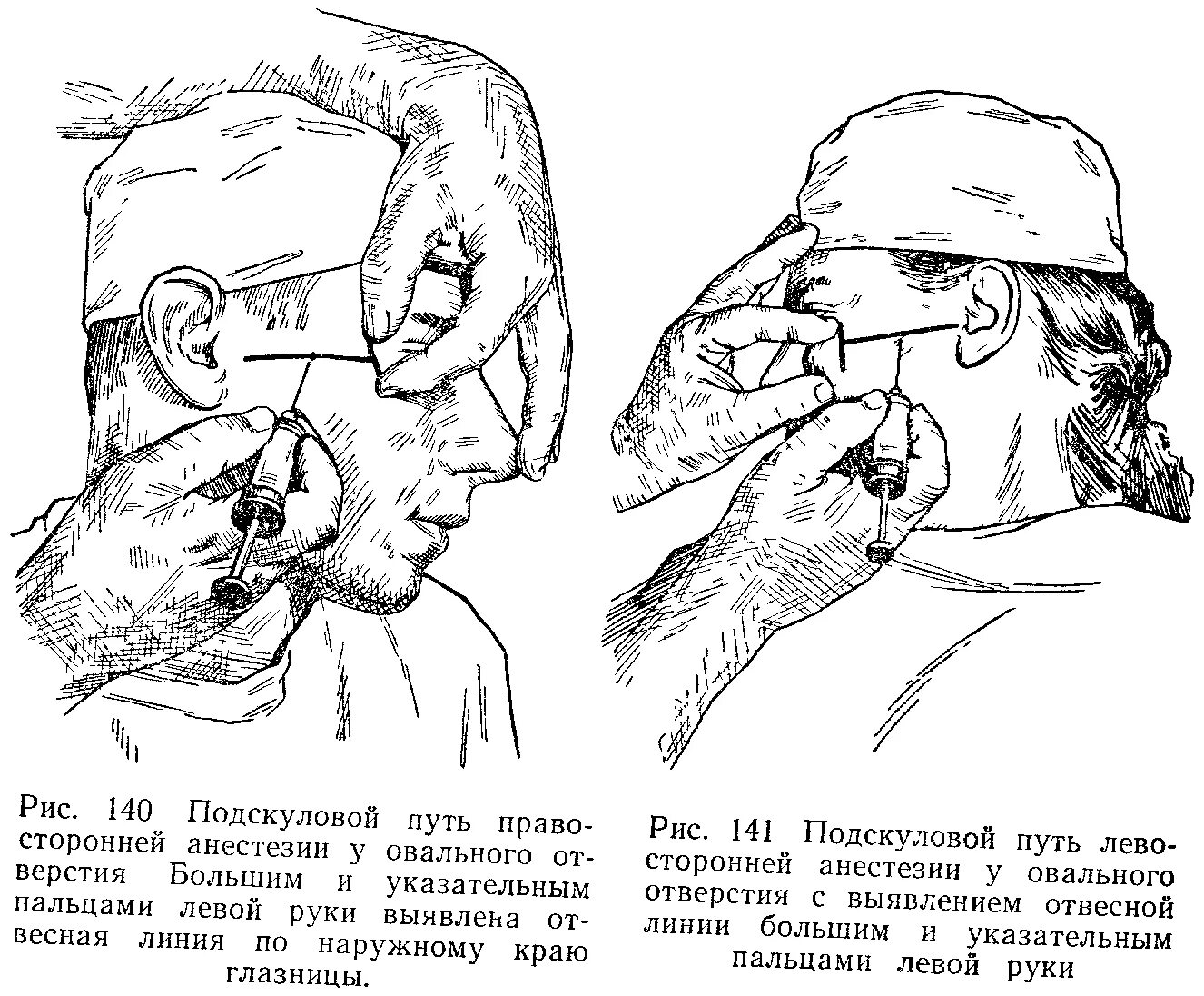 Блокада тройничного. Анестезия у овального отверстия по Вайсблату. Стволовая анестезия подскуловой метод. Обезболивание верхнечелюстного нерва (стволовая анестезия). Анестезия у круглого отверстия по Вайсблату.