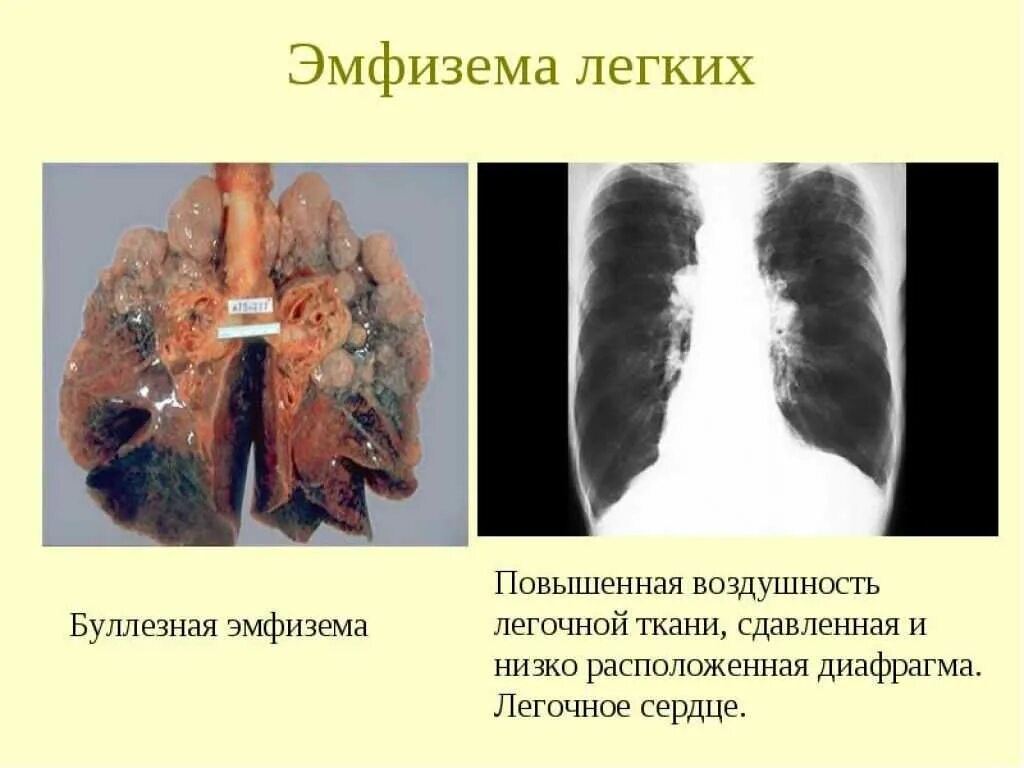 Процесс в легких вызванный. Заболевание буллезная эмфизема. Периацинарная эмфизема. Экспираторная эмфизема