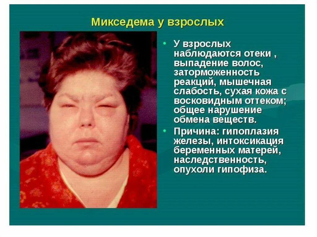 отекает лицо гормоны